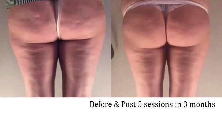 Cellulite Before After 4 Cellulite Before After 4