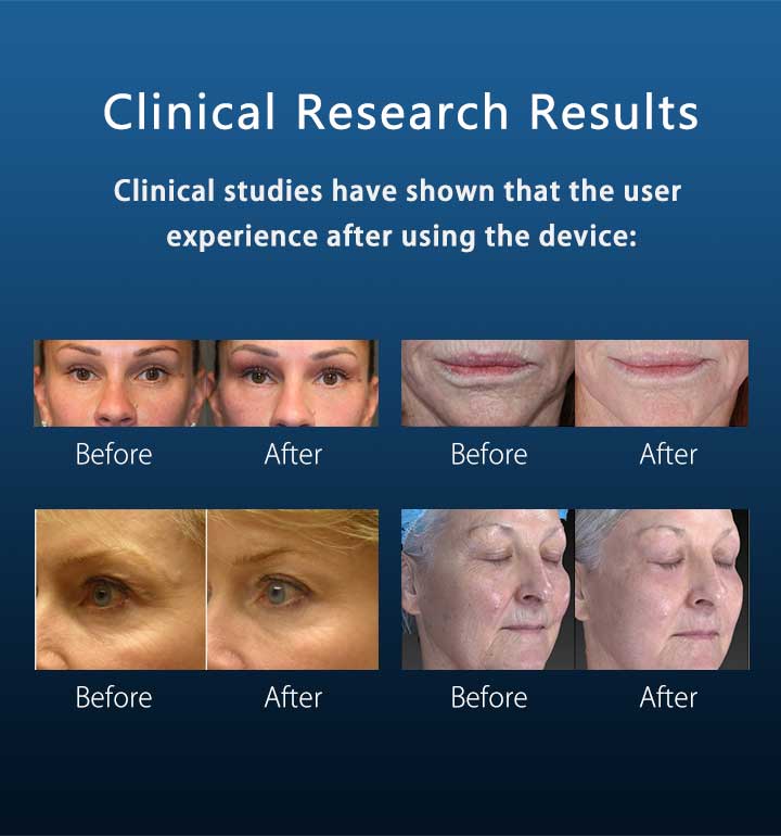 RF fractional microneedle9