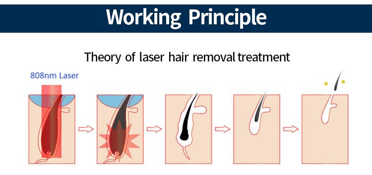 diode laser hair removal machine3 diode laser hair removal machine3