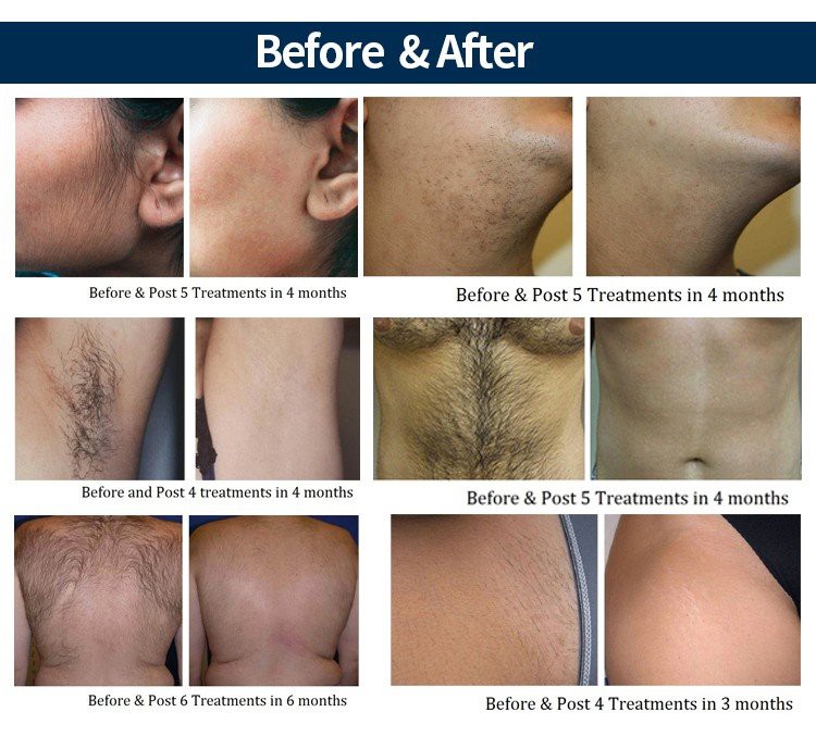 diode laser hair removal machine4 diode laser hair removal machine4